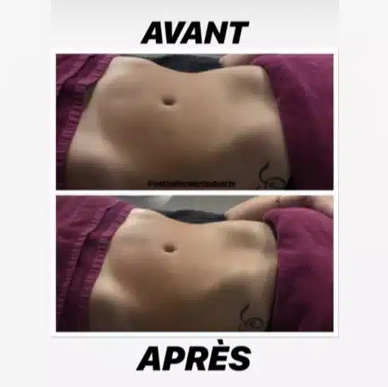 massage renata franca avant après