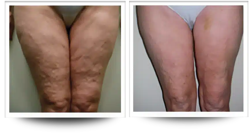 drainage lymphatique jambes gonflées