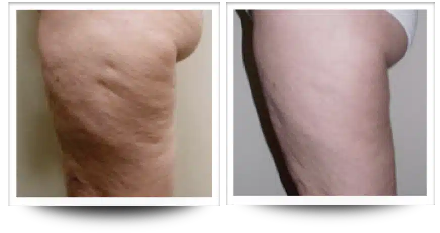 drainage lymphatique cuisse