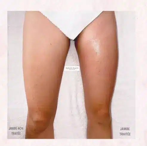 drainage lymphatique cuisse