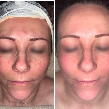 Accent Prime - Visage